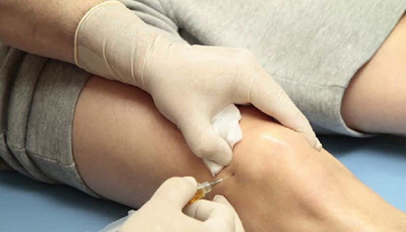 Treating Osteoarthritis With Stem Cell Injections